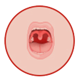 mouth cancer